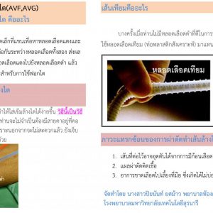 การผ่าตัดทำเส้นเพื่อล้างไต