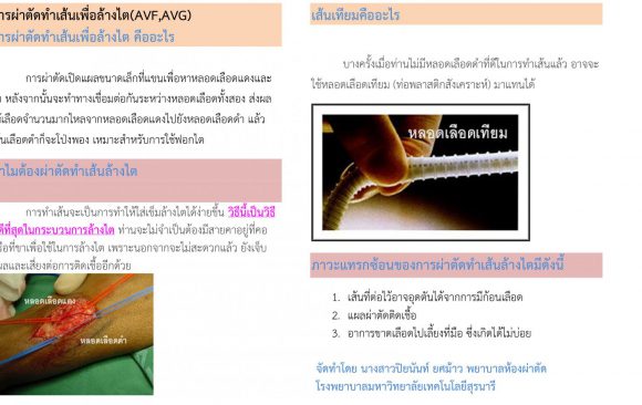 การผ่าตัดทำเส้นเพื่อล้างไต